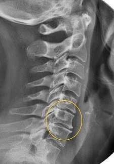 Rétrécissement de l'espace intervertébral à la radiographie