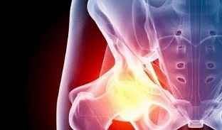 causes du développement de l'arthrose de la hanche