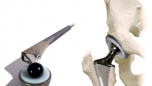 endoprothèses de l'articulation de la hanche pour l'arthrose