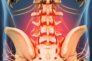 causes et symptômes de l'ostéochondrose