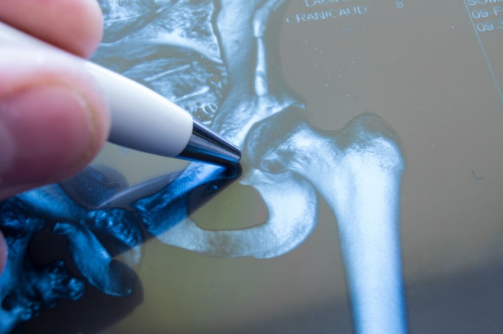 Arthrose de l'articulation de la hanche sur la radiographie