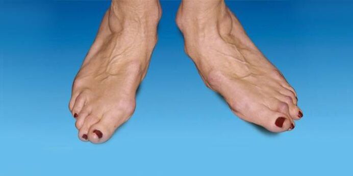 déformation du pied avec arthrose de la cheville