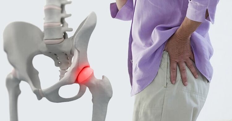 douleur dans la région de la hanche - un symptôme d'arthrose de l'articulation de la hanche