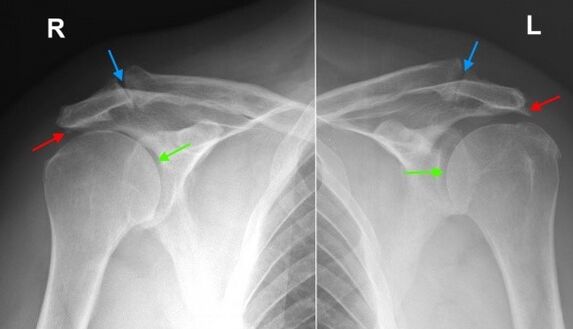 Radiographie des articulations de l'épaule