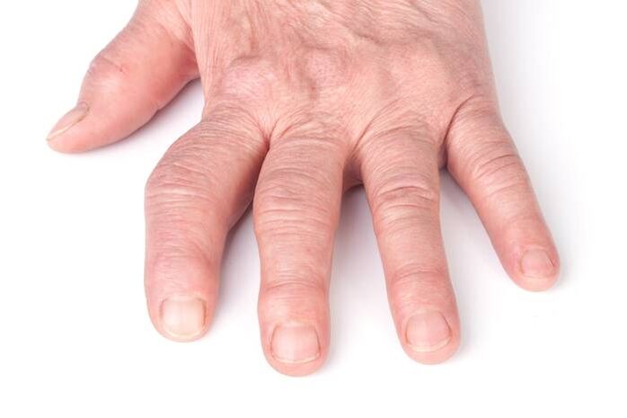 arthrose déformante des mains