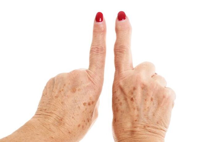 arthrose déformante sur les doigts