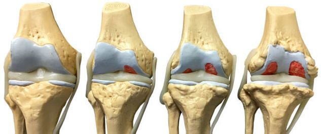 lésions articulaires à différents stades de développement de l'arthrose de la cheville