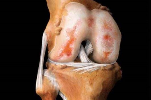 dommages à l'articulation du genou avec arthrose