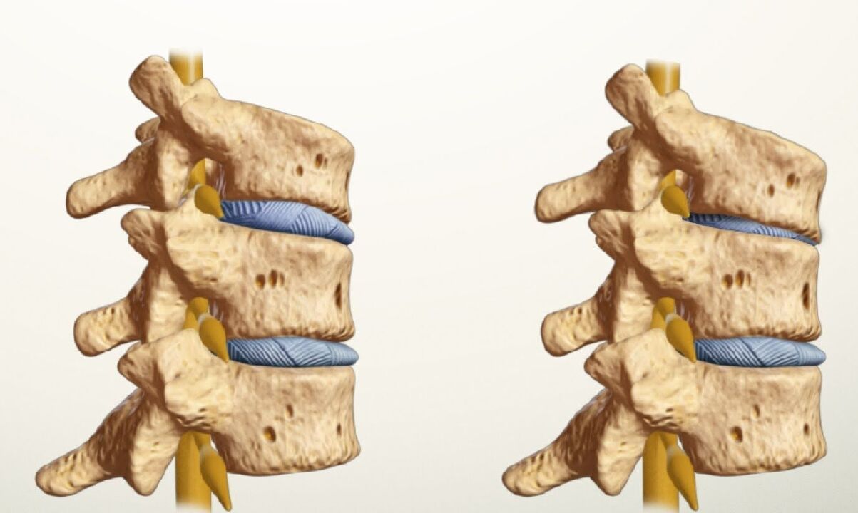 colonne vertébrale saine et malade avec ostéochondrose lombaire