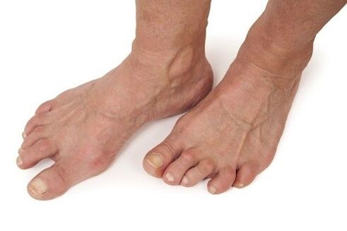 pieds touchés par l'arthrose