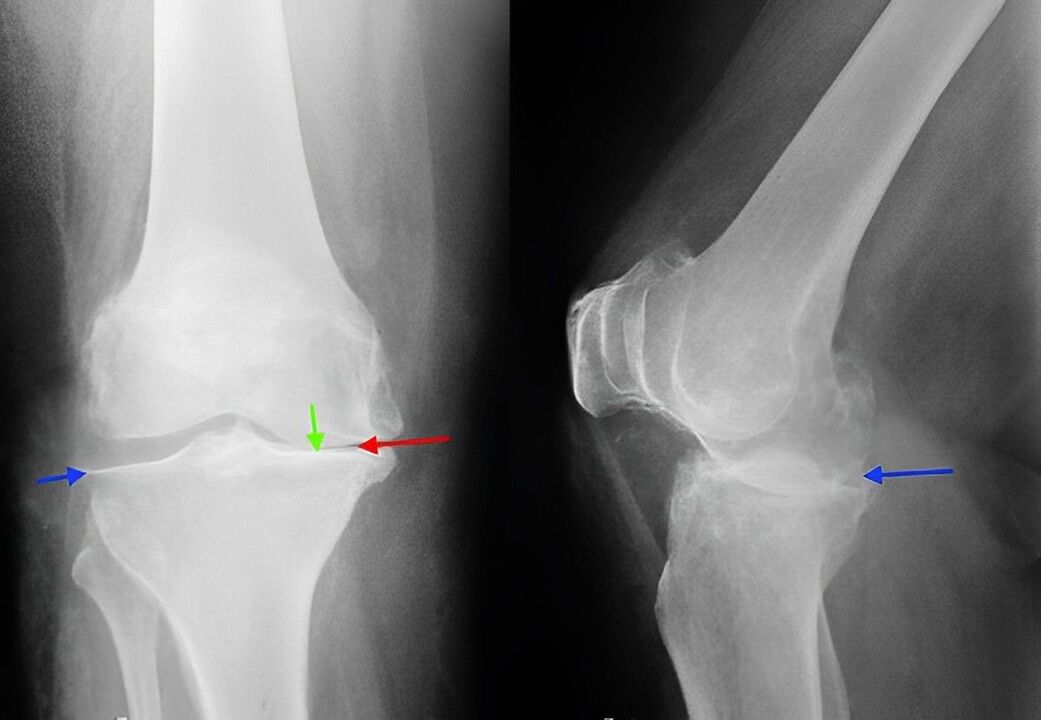 radiographie de l'arthrose de l'articulation du genou