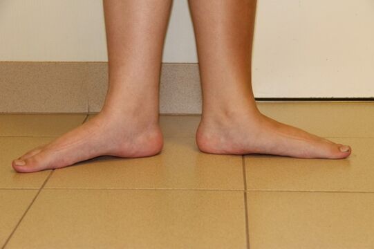 Parfois, la cause de l'arthrose du cou est les pieds plats