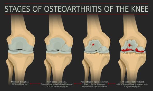 développement de l'arthrose articulaire