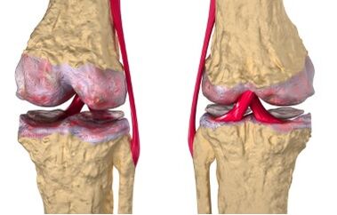 Les varices sont à l'origine du développement de la gonarthrose